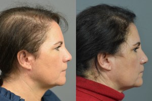 before and after hair restoration