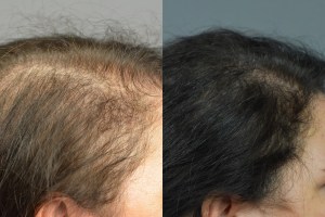 before and after close up