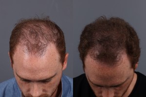 000001 marotta hair transplant before and after