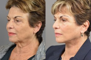 CP-4293-LO marotta plastic surgery before and after female
