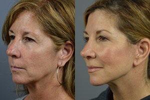 TS_7157_AP_Aft_Facial-Rej-Rhino-ba marotta plastic surgery before and after female